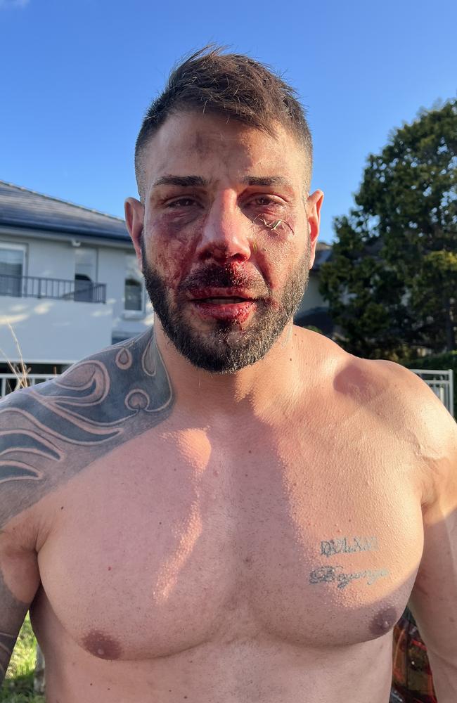 Samet Karasoylu after the incident in Greenwich. Picture: Supplied