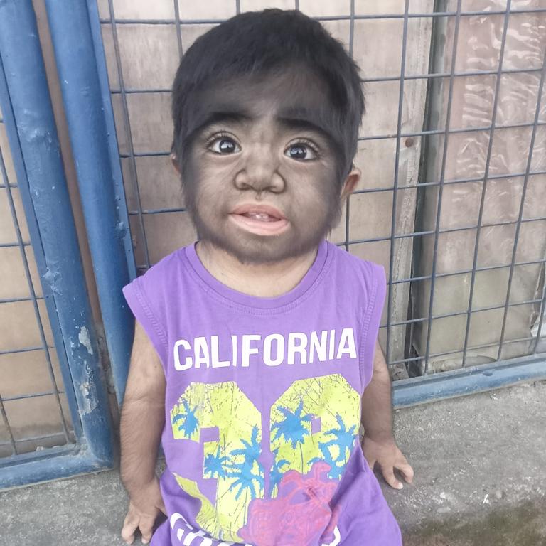 Two-year-old boy has one-in-a-billion ‘werewolf syndrome’ | news.com.au ...