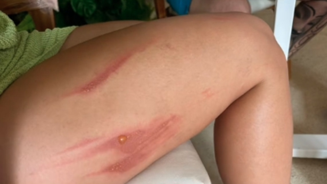 Her welts started off small as the pain worsened. Picture: Tiktok