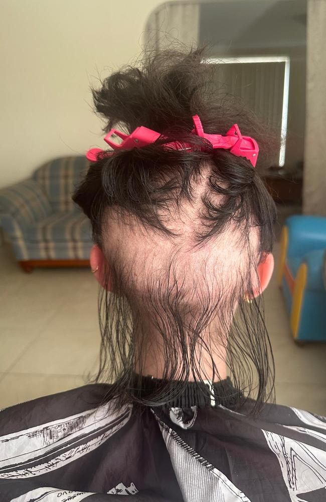 She has started losing her hair. Picture: Supplied