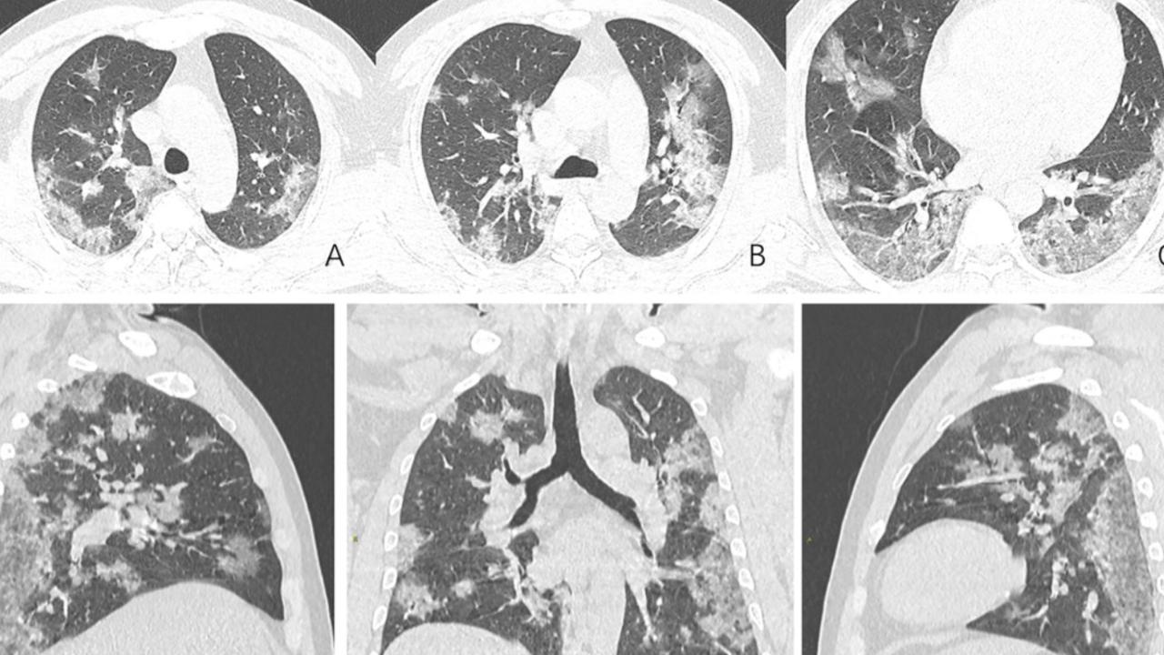 Classic white opacities found in the lungs of coronavirus patients left by detritus from the immune response. Picture: Lijuan Qian, Jie Yu and Heshui Shi