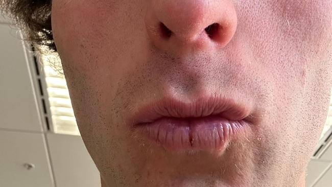 16. How quickly I got cracked lips Note to self: when surfing in Indonesia, put zinc on your lips. 