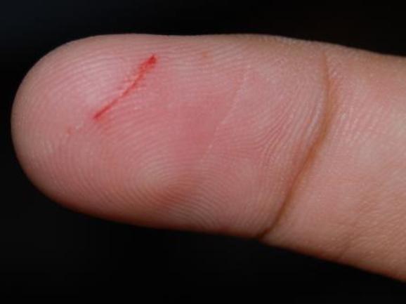 STINGING pain that accompanies paper cuts seems out of all proportion. But, as it turns out, there are some very good reasons.