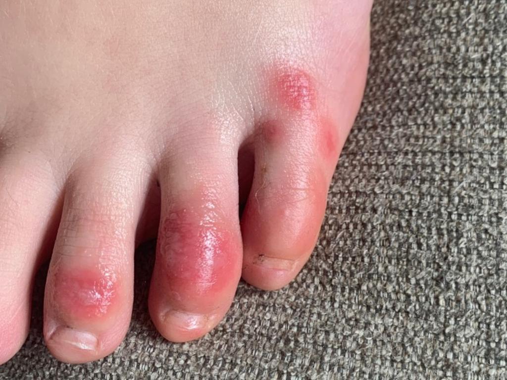 COVID toes are said to be one of the symptoms of coronavirus. Picture: Dr Amy Paller, Northwestern University