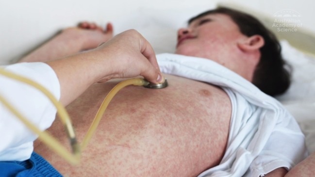 New hard-hitting campaign to warn people of the dangers of measles