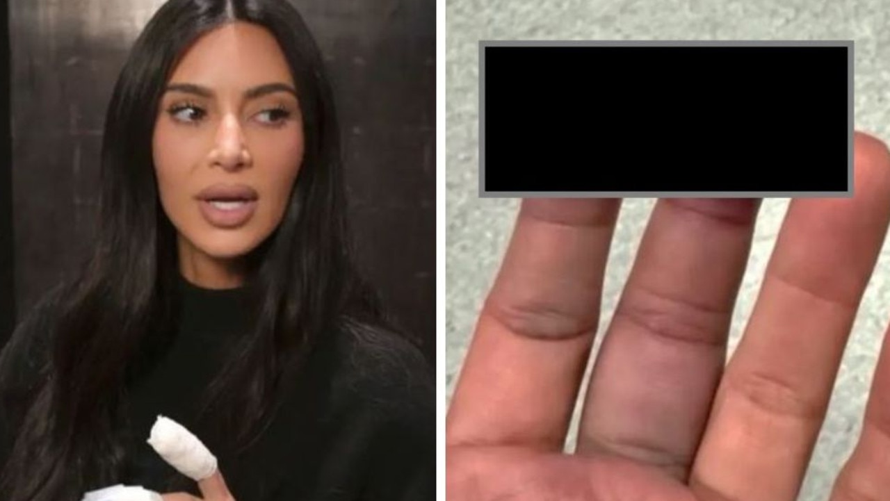 Kim Kardashian suffers gruesome injury