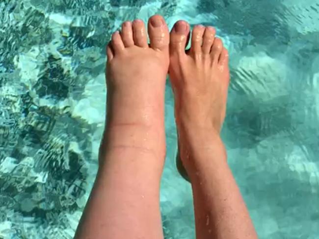 PIC FROM CATERS NEWS - (PICTURED: The difference in size between Sarahs legs. ) - A former model has been left with a ginormous leg after her pregnancy caused the limb to double in size. Sarah Buller, 31, from Perth, Australia, was left horrified when her left leg began ballooning when she was three months pregnant. Doctors diagnosed Sarah with primary lymphoedema - an incurable condition that causes swelling in the bodys tissues - after shed given birth. Sarahs pregnancy had triggered a chronic problem with her lymphatic system, meaning the lymph fluid is unable to circulate around her leg properly now leaving it weighing two stone. The mum-of-two, currently living in Nice, France, now spends hours every day bandaging her leg, using compression socks, exercising and having massages in a bid to relieve the excess fluid. SEE CATERS COPY.