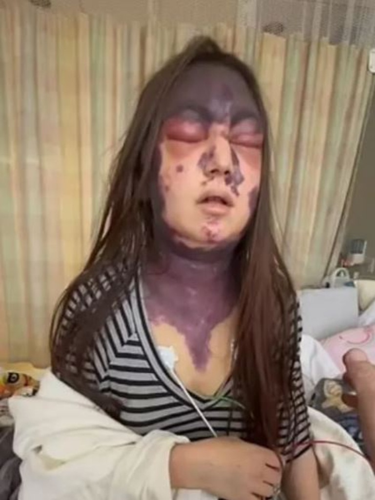 She was left temporarily blind with agonising purple bruises spreading across her face. Picture: Facebook