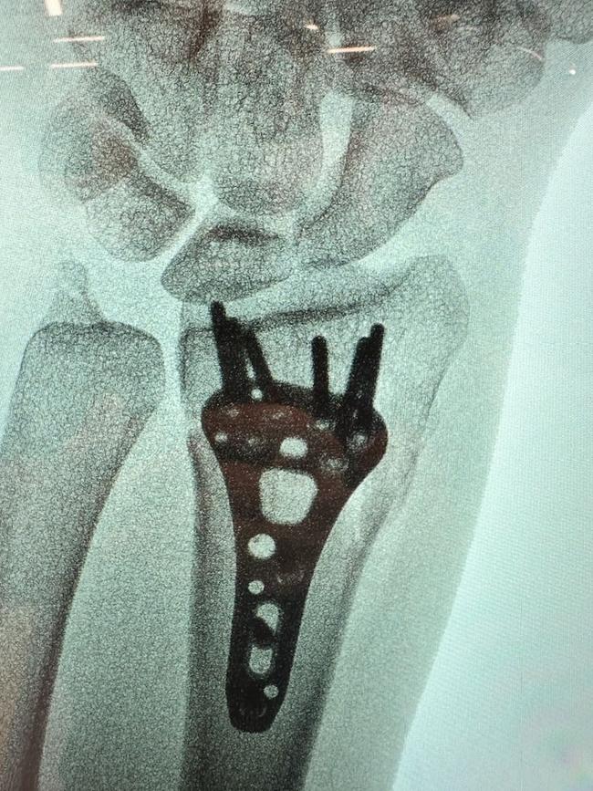 Alice Kunek's wrist is held together by a metal plate and screws.