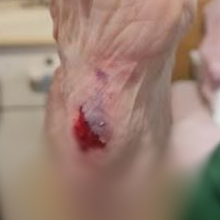 One aged care resident suffered injuries after falling getting on a bus without help. Picture: Supplied