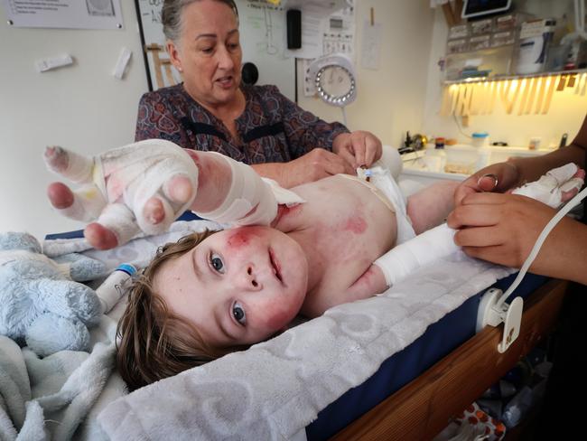 Jacob has bandages painstakingly removed by RCH support worker Rose Rice and complex care nurse Bianca Dy. Picture: David Caird