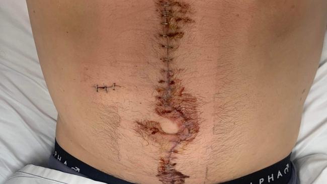 Ryan Duck's abdomen after surgery following an alleged knife attack at Pacific Palms on November 27, 2022. An alleged knife wound is seen on the left. Picture: Supplied