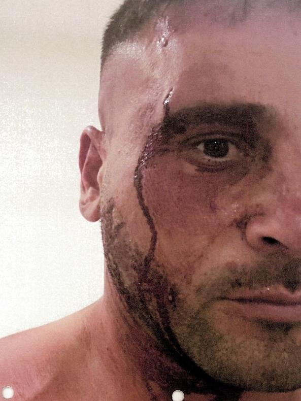 El Haje was bloodied, bruised and sustained a fractured cheekbone.