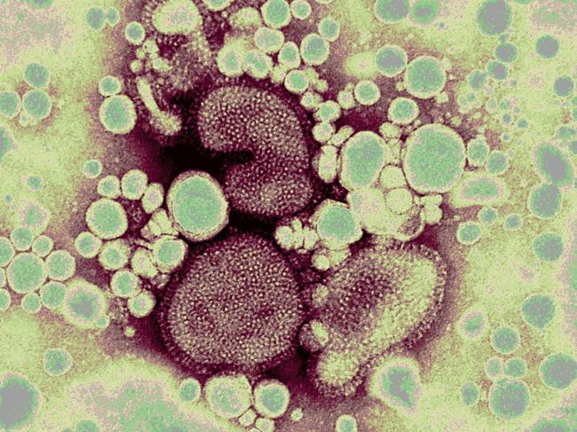 07/11/2005. Bird flu virus globules under the microscope. Pic From CSIRO, Livestock Industries Australian Animal Health Laboratory, Geelong.