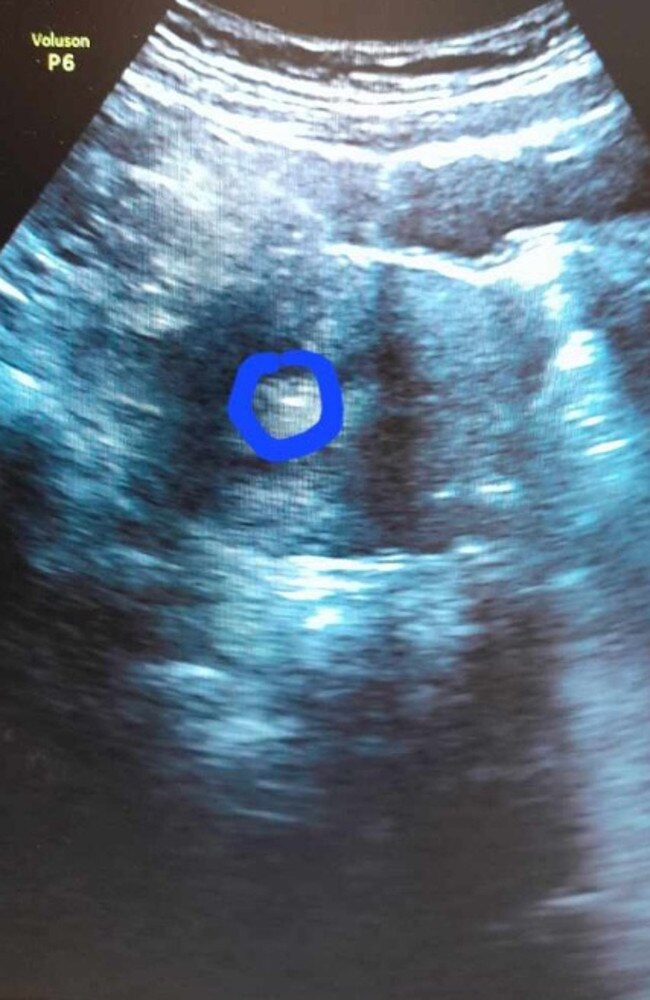 Charlotte's embryo after it was implanted within the uterus of her surrogate mother, Josie. Picture: Supplied