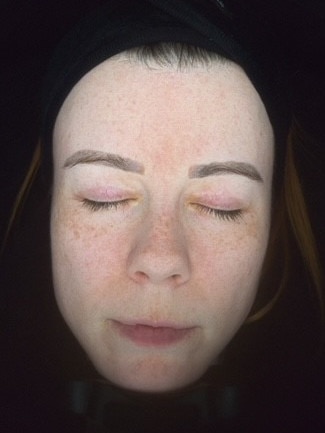 … and just two months in – already visibly lighter and with reduced redness and pigmentation. Picture: Rebekah Scanlan