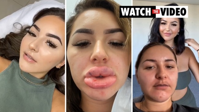 Anna Paul gets her lip fillers dissolved