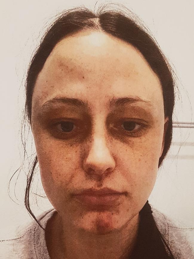 Injuries sustained by SA Police Constable Anthea Beck, allegedly inflicted by Raina Jane Cruise. Picture: District Court registry