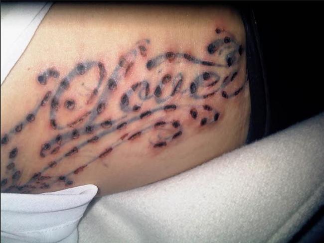 Tattoo removal: Laser machines causing horrific skin damage