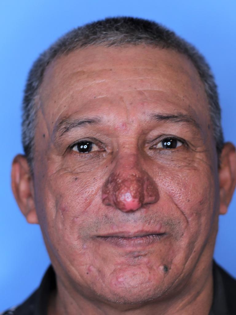 Painter Conrado Estrada after is nose surgery. Picture: Supplied.