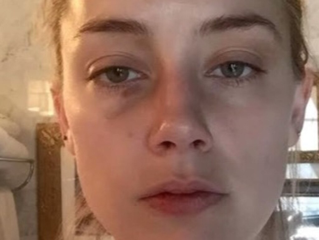 Amber Heard with injuries she claims were inflicted by Johnny Depp in a picture shown to court. He denies physical abuse.