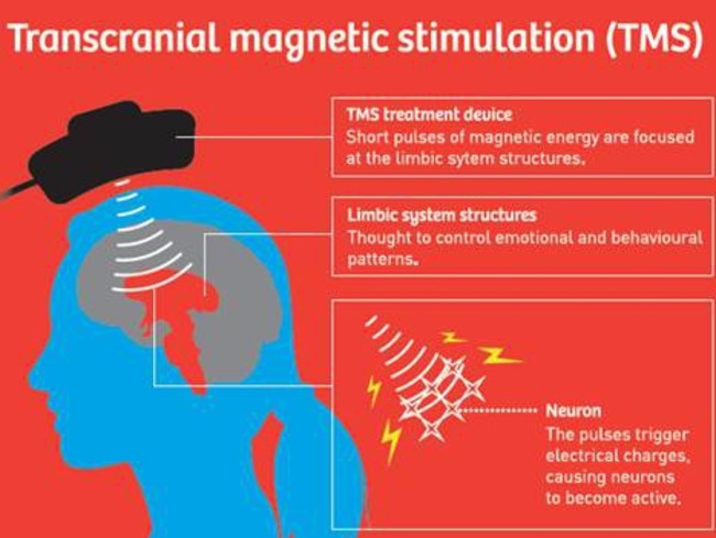 Transcranial Magnetic Stimulation is being used in a trial by Medibank and the Adelaide Clinic. Picture: Supplied.