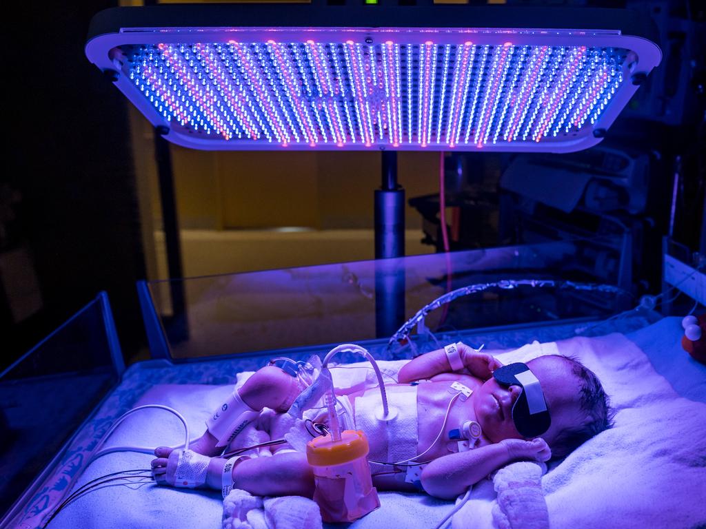 New phototherapy machine to treat jaundice in babies donated to