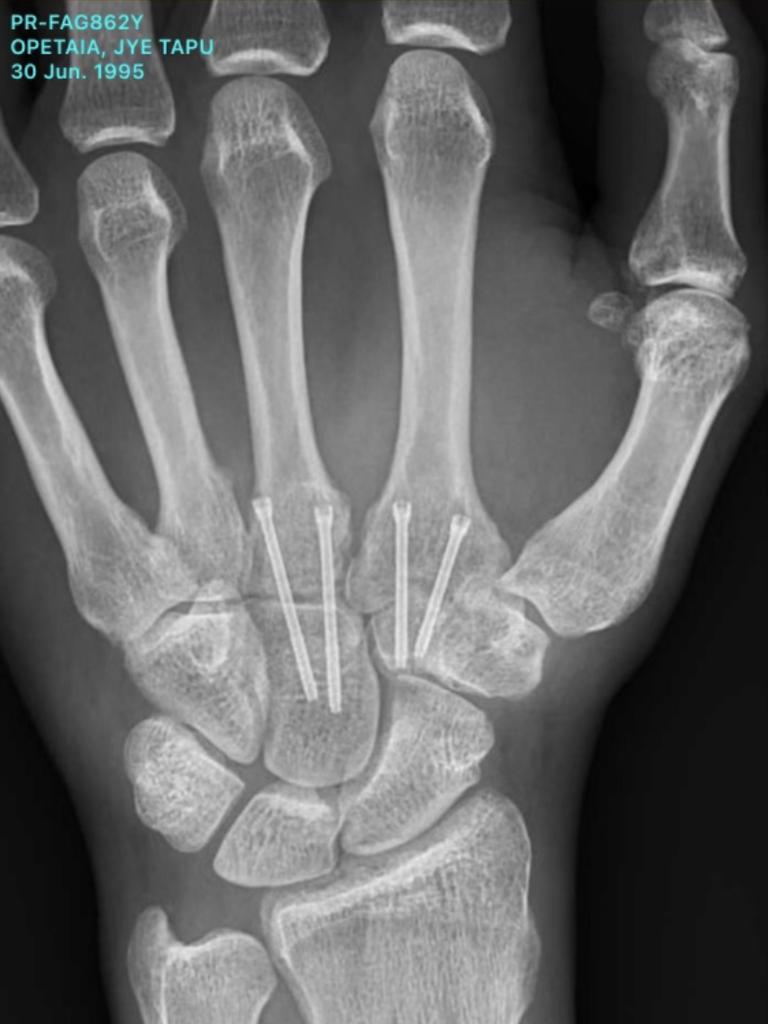 An X-ray of Jai Opetaia's hand, after finally having surgery on the hand that's been fractured since 2015.