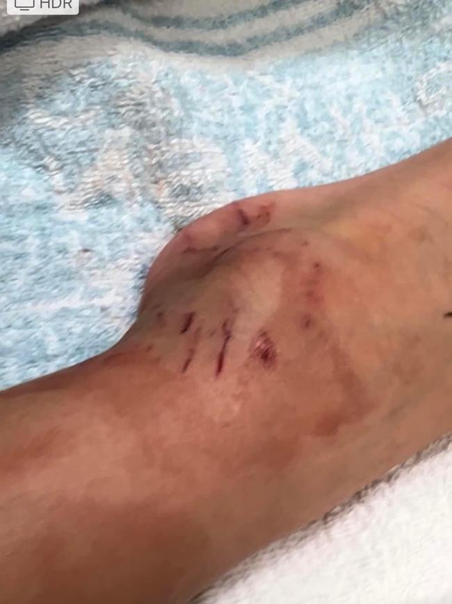 Beau’s ankle after the snake bite.