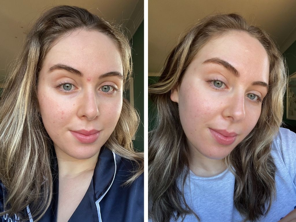 This is my before (left) and after (right) from exclusively using Skinceuticals products for four weeks. Picture: Supplied/Marina Tatas