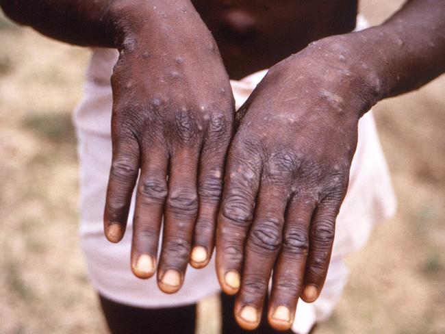 A patient displays the appearance of the characteristic rash of monkeypox during its recuperative stage. Picture: AFP