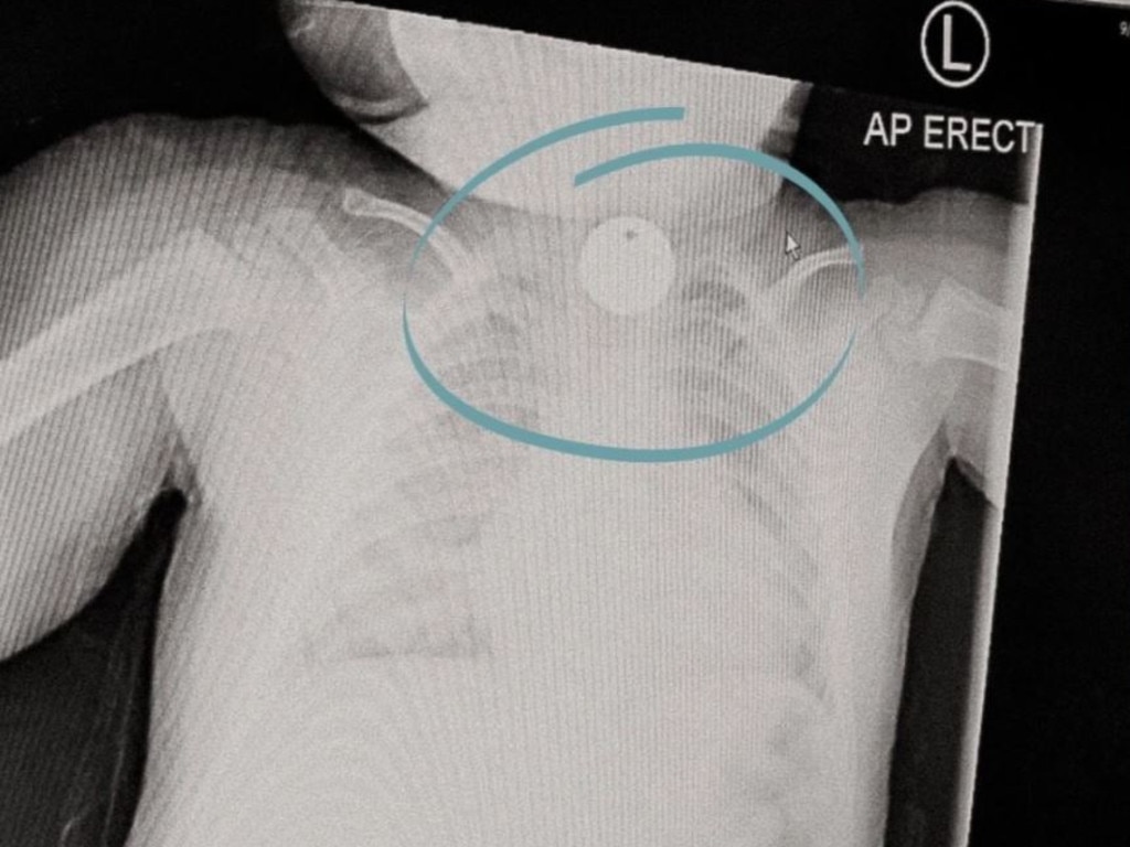 An X-ray revealed that the baby had swallowed a small object that the mum recognised straight away as an Aldi trolley token. Picture: tinyheartseducation