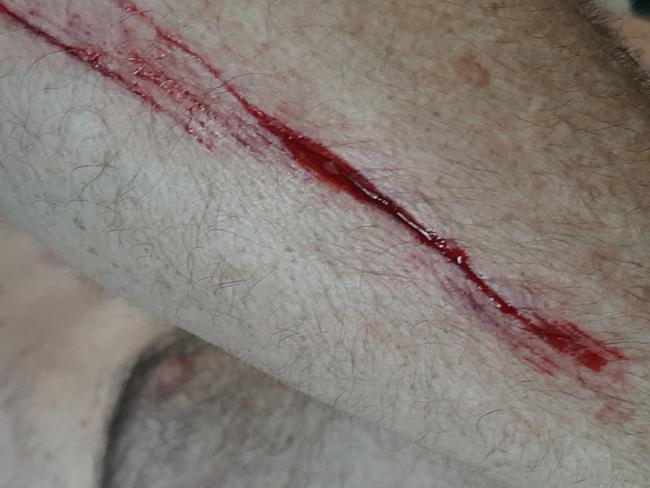 A gash Mr French sustained while protecting his dog Patch from being mauled by a bullmastiff.