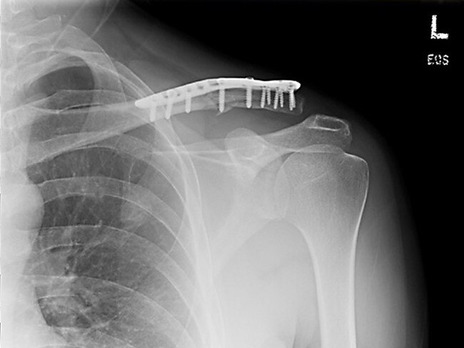 X-rays of the broken collarbone suffered by Liam Thompson while riding a Lime scooter. Pic Supplied