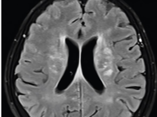 MRI scans reveal have the white matter lesions (in the centre of the brain scan) only increased after the first round of antibiotics