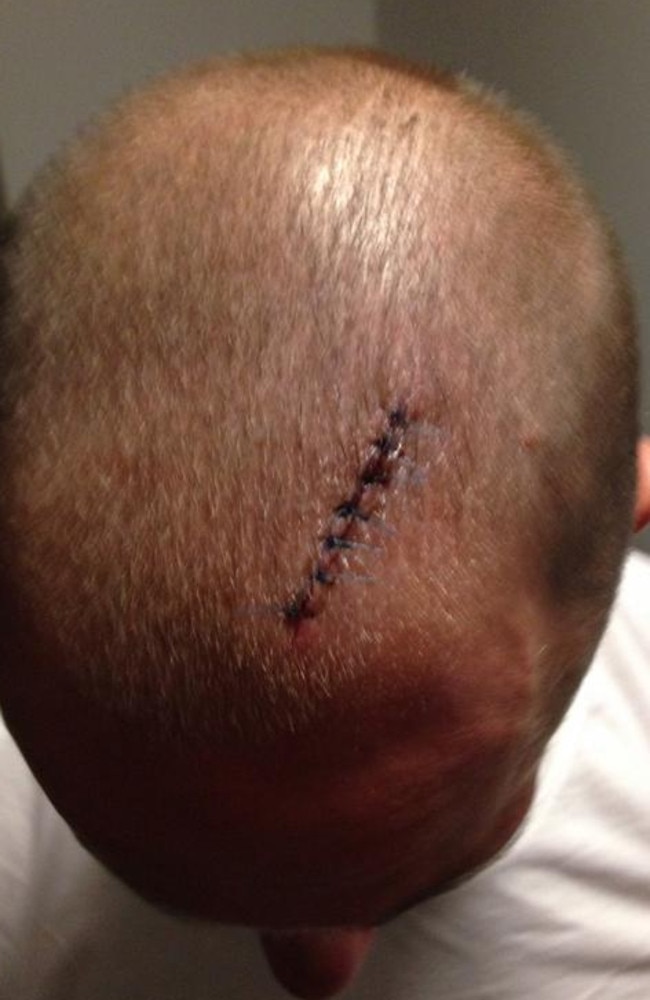 Jeff Robson’s head injury after the game against the Cowboys.