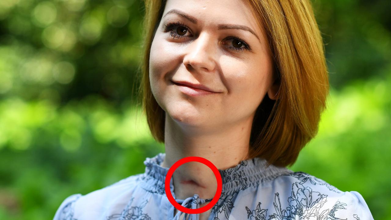 Ex Spys Poisoned Daughter Yulia Skripal Recovering With Neck Scar