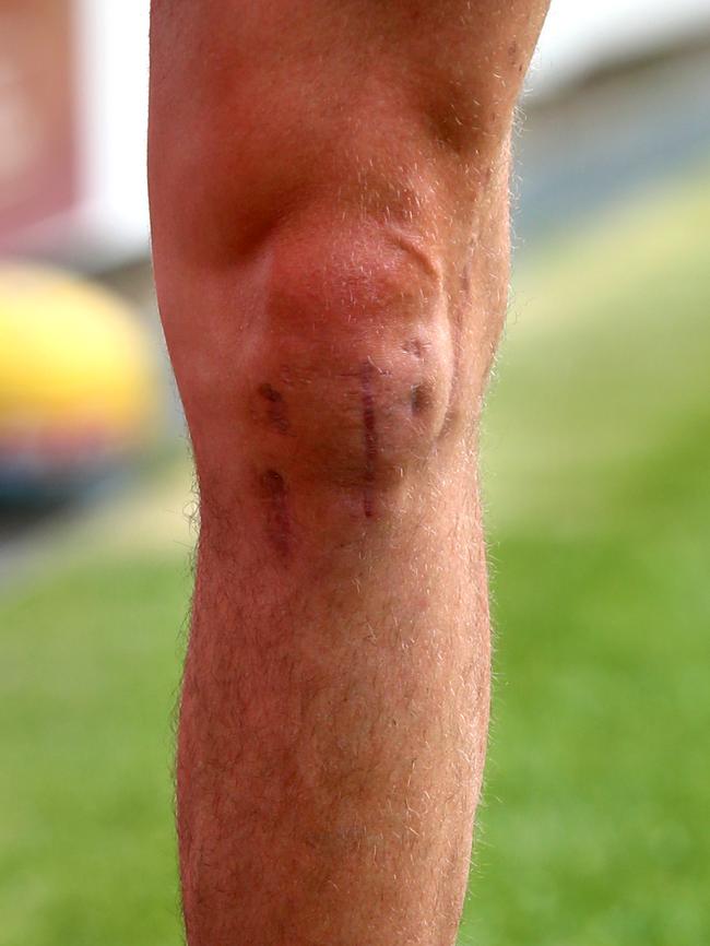 The scars on Alex Johnson’s knee from multiple knee surgeries. Picture: Gregg Porteous