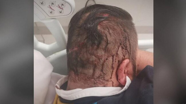 The victim of an assault outside of a North Adelaide cafe was struck on the head with a metal pipe. Pictures: 7 News