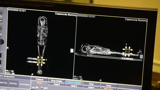 Doctors found the tumour in the man’s fibula.