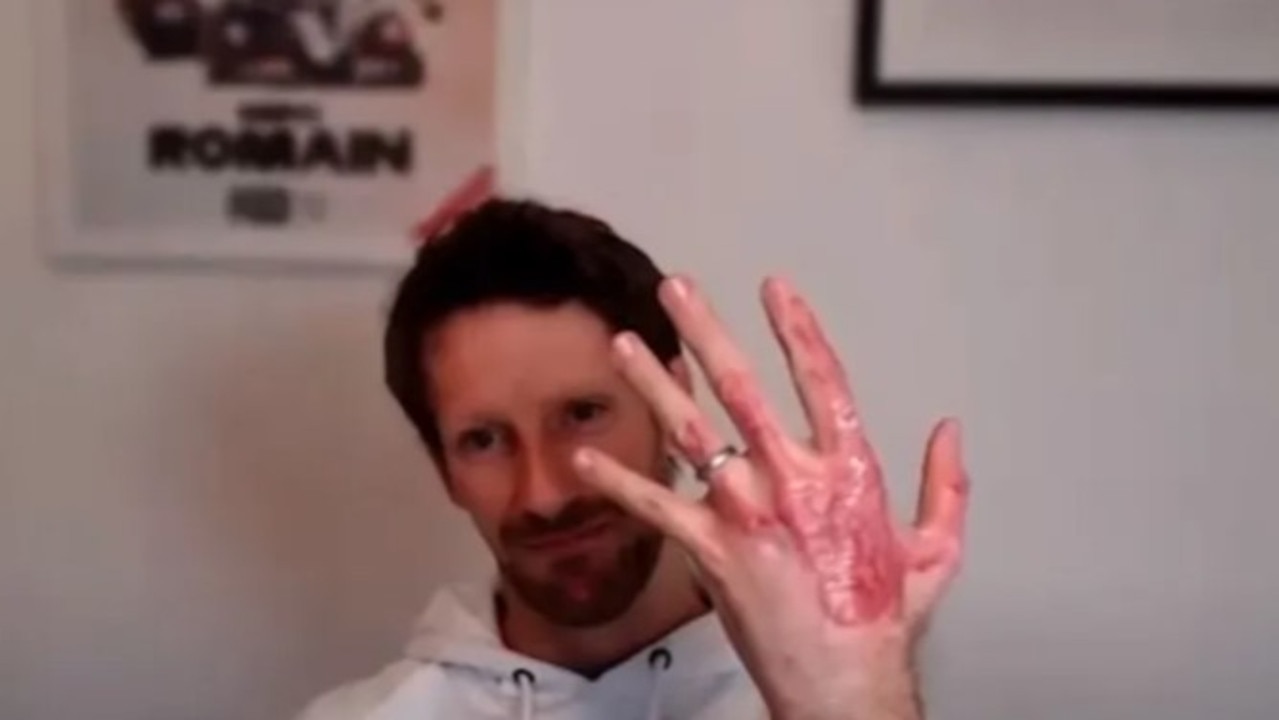Romain Grosjean shows off his scars a year on. Photo: YouTube