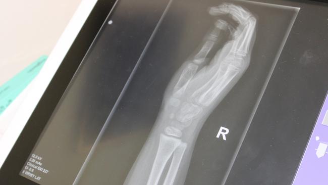 An X-ray from Yulara’s new X-ray machine. Picture: Supplied