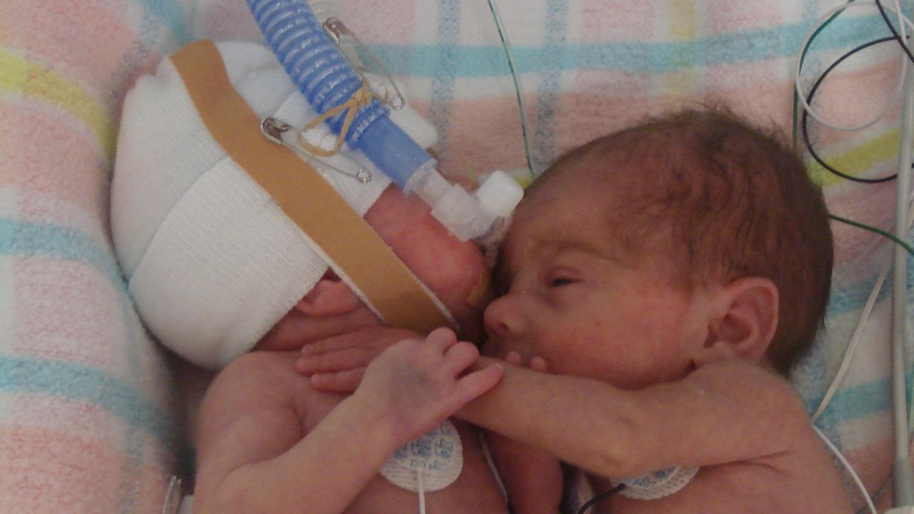 Meet our miracle twins … 17 years after the fight of their lives