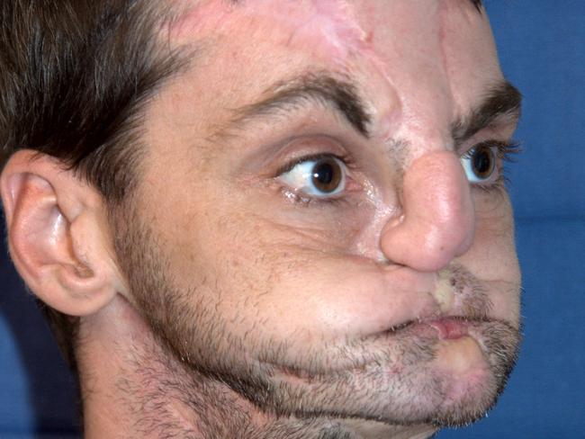 In photos provided by the University of Maryland Medical Center, face transplant recipient Richard Lee Norris, the recipient of the most extensive face transplant performed to date, is seen a photo taken before the face transplant, left, and in a photo made 114 days after the transplant was performed. Norris, 37, of Hillsville, Va. received the transplant in a 36-hour operation in March 2012. It included the replacement of both jaws, teeth, tongue, and skin and underlying nerve and muscle tissue from scalp to neck. Norris was injured in a gun accident in 1997. (AP Photo/ University of Maryland Medical Center)