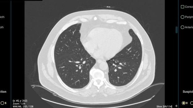 Image from CovED techology of someone with no symptoms of COVID-19. Picture: DetectED-X