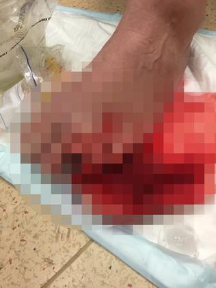The missing toe (pixilated image).
