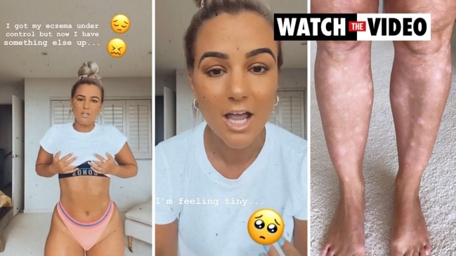 Karina Irby opens up about fungal skin condition