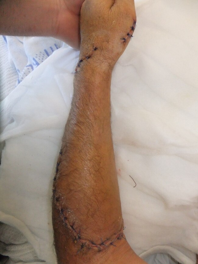 Pearson’s stitched up arm'.