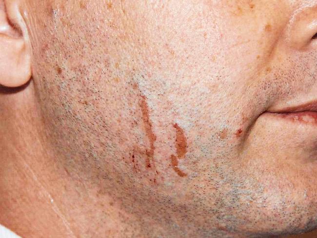 140726 TWAM Court exhibit from the Gerard Baden-Clay murder trial. Images of scratches and cuts on Gerard Baden-Clay's body. Picture: Captioned As