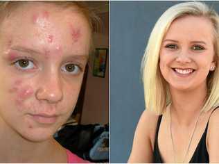 Fraser Coast Chronicle journalist Inge Hansen suffered from cystic acne in her early teens and was bullied as a result. Picture: Inge Hansen